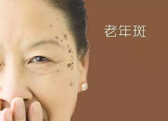 老年斑要警惕三种病：老年斑不只是衰老，这三种病要当心