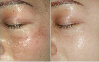 老年斑要警惕三种病：老年斑不只是衰老，这三种病要当心