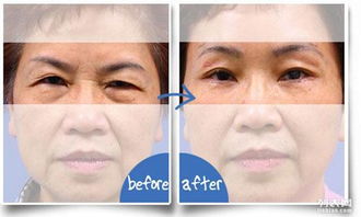 眼部矫正手术大概需要多少钱：眼部矫正手术价格参考，全面解析费用构成与选择要点