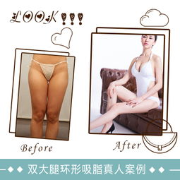 大腿抽脂:大腿抽脂,全面解析,了解吸脂塑形的科学与选择 大腿抽脂:大腿抽脂,全面解析,了解吸脂塑形的科学与选择