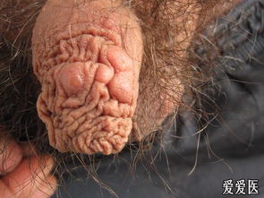 阴囊痒痒越抓越痒什么原因:阴囊奇痒难耐,真相竟然是这样! 阴囊痒痒越抓越痒什么原因:阴囊奇痒难耐,真相竟然是这样!