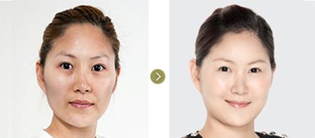 祛黄褐斑的方子:中医祛黄褐斑秘方,安全有效的自然疗法指南