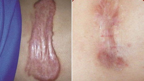 凹陷疤痕可以完全修复吗:凹陷疤痕可以完全修复吗?疤痕修复的真相与可能性