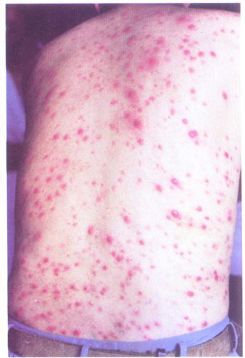 猩红热早期症状图片:猩红热早期症状及图片识别指南