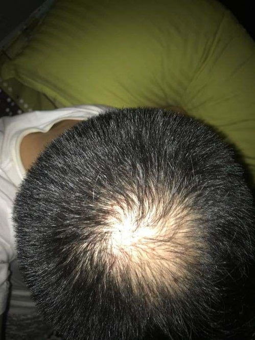 脂溢性脱发怎么改善:告别头油烦恼,有效改善脂溢性脱发的方法全解析 脂溢性脱发怎么改善:告别头油烦恼,有效改善脂溢性脱发的方法全解析