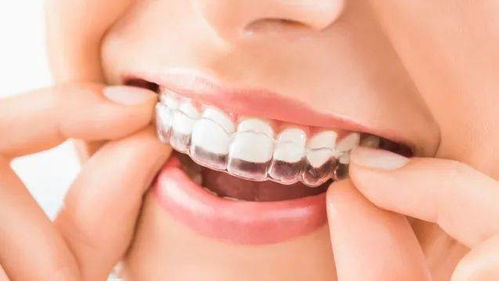 带牙套多少钱:带牙套到底要花多少钱?全面解析与省钱攻略 带牙套多少钱:带牙套到底要花多少钱?全面解析与省钱攻略