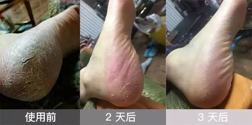 阴囊瘙痒脱皮干裂发硬:阴囊瘙痒脱皮干裂发硬,原因与应对措施