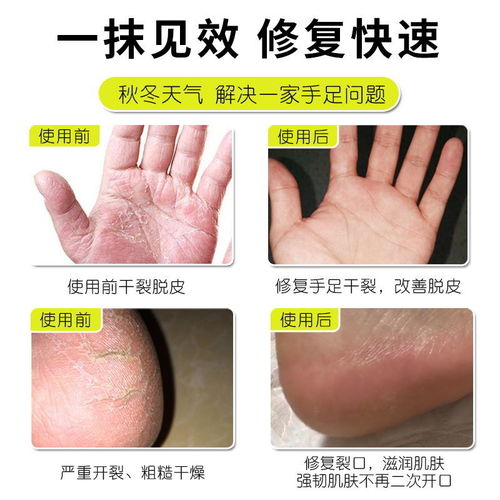 阴囊瘙痒脱皮干裂发硬:阴囊瘙痒脱皮干裂发硬,原因与应对措施 阴囊瘙痒脱皮干裂发硬:阴囊瘙痒脱皮干裂发硬,原因与应对措施