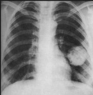 肺部鳞状肿瘤能治愈吗:肺部鳞状肿瘤能治愈吗?最新治疗方案带来希望 肺部鳞状肿瘤能治愈吗:肺部鳞状肿瘤能治愈吗?最新治疗方案带来希望