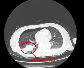 肺部鳞状肿瘤能治愈吗：肺部鳞状肿瘤能治愈吗？最新治疗方案带来希望