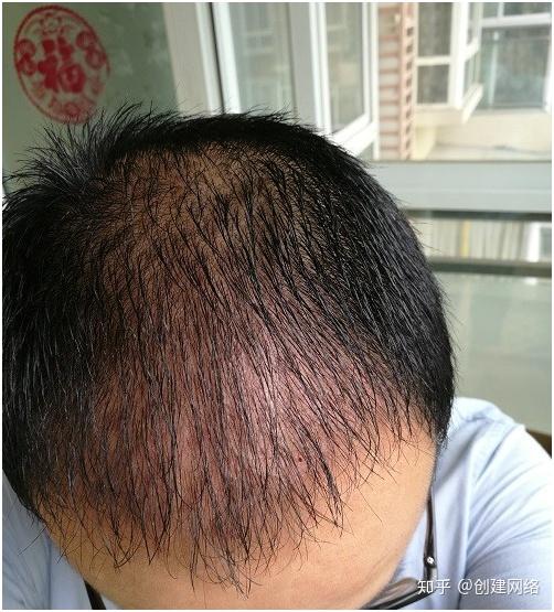 植发会不会再次脱落:植发会不会再次脱落?科学解析植发效果持久性 植发会不会再次脱落:植发会不会再次脱落?科学解析植发效果持久性