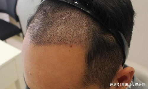 植发会不会再次脱落:植发会不会再次脱落?科学解析植发效果持久性 植发会不会再次脱落:植发会不会再次脱落?科学解析植发效果持久性