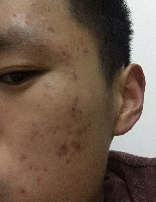 怎么有效去除痘痘和痘印:告别痘痘烦恼,有效去除痘痘与痘印的科学指南