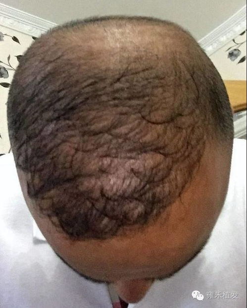 植发价格多少钱左右:植发价格到底要花多少钱?一份全面解析助你了解费用区间