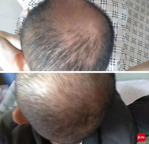 植发价格多少钱左右:植发价格到底要花多少钱?一份全面解析助你了解费用区间 植发价格多少钱左右:植发价格到底要花多少钱?一份全面解析助你了解费用区间