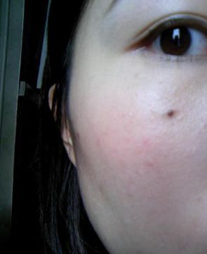 脚上长鸡眼怎么办：脚上长鸡眼怎么办？这些方法帮你轻松解决