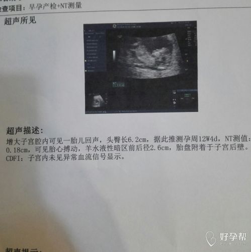 nt检查需要空腹吗:nt检查需要空腹吗?答案来了!