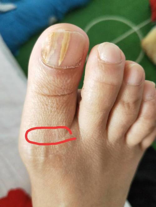 大脚趾指甲边缘一按就疼：大脚趾指甲边缘一按就疼？可能是这些原因在作祟！