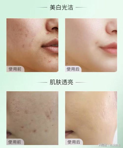 肌漾祛痘印有效果吗:肌漾祛痘印有效果吗?真实体验分享与分析