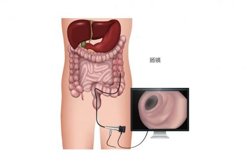 做肠镜有息肉当场就割吗:肠镜发现息肉,医生会当场切除吗?看完这篇你就明白了!