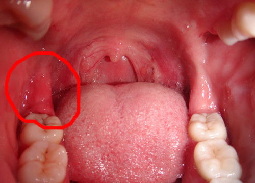 右边脖子上有个滑动的小结节:右边脖子上有个滑动的小结节,你需要知道的那些事