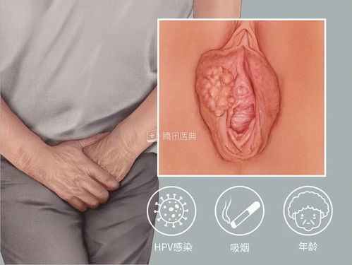 下体瘙痒有豆腐渣是怎么回事：下体瘙痒有豆腐渣是怎么回事？警惕这些妇科炎症信号！