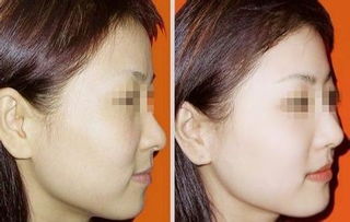 光子嫩肤三年后感受:光子嫩肤三年后的真实感受,皮肤真的变好了吗?