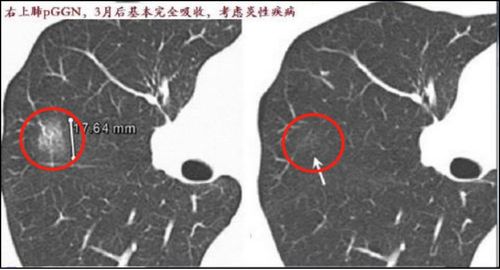 肺结节能自愈消失吗:肺结节能自愈消失吗?真相在这里!