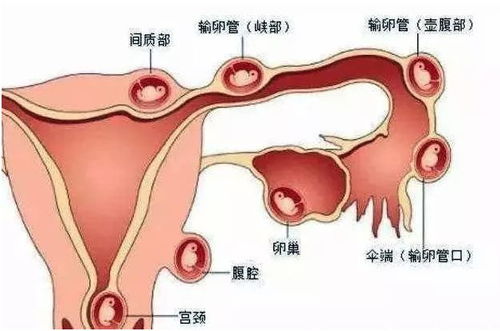 女性肾结石初期症状：女性肾结石初期症状，警惕这些信号，早发现早治疗！