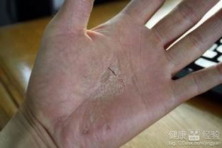 阴囊湿疹用什么药根治：阴囊湿疹用什么药根治？专家详解病因、药物与生活管理