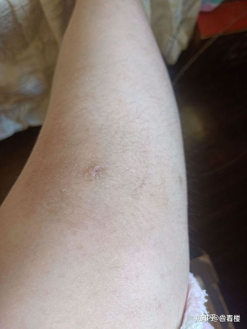 疥疮的症状及图片:疥疮的症状及图片解析,你了解多少? 疥疮的症状及图片:疥疮的症状及图片解析,你了解多少?