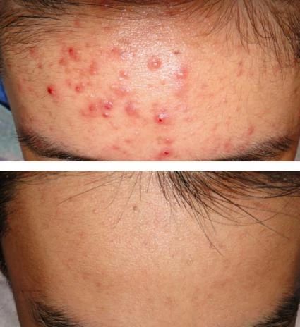 疥疮的症状及图片:疥疮的症状及图片解析,你了解多少? 疥疮的症状及图片:疥疮的症状及图片解析,你了解多少?