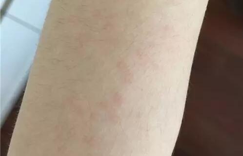 疥疮的症状及图片:疥疮的症状及图片解析,你了解多少? 疥疮的症状及图片:疥疮的症状及图片解析,你了解多少?