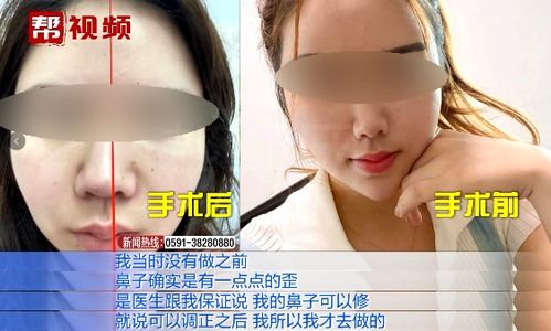 做鼻子要花多少钱：揭秘，隆鼻手术到底要花多少钱？价格影响因素全解析
