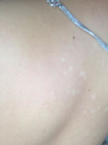 背上长白斑是什么病的症状：背部长白斑，这些病因你了解吗？