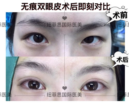 埋线双眼皮过程视频：揭秘，埋线双眼皮全过程视频展示，无创双眼皮手术新选择！