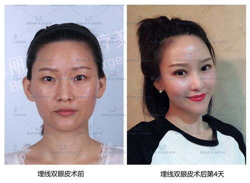 埋线双眼皮过程视频：揭秘，埋线双眼皮全过程视频展示，无创双眼皮手术新选择！