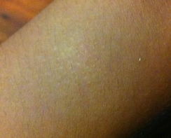 皮肤痒挠过后像癣一样:警惕!抓痒后皮肤变癣样,这些原因你必须知道 皮肤痒挠过后像癣一样:警惕!抓痒后皮肤变癣样,这些原因你必须知道