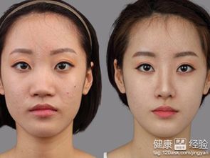 缩小鼻孔手术一般多少钱:缩小鼻孔手术价格参考,了解费用与注意事项 缩小鼻孔手术一般多少钱:缩小鼻孔手术价格参考,了解费用与注意事项