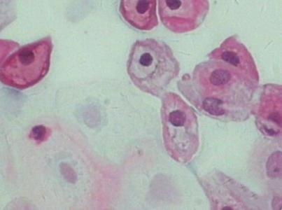 男性根部长了个疣:男性根部长了个疣?警惕尖锐湿疣,莫忽视这小东西