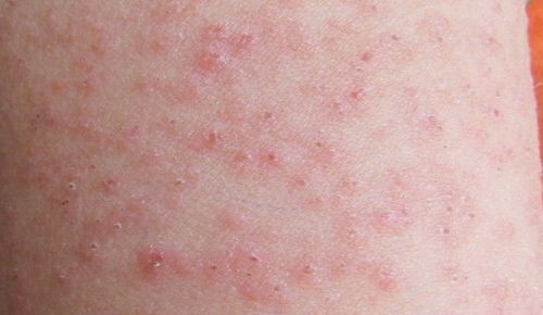 荨麻疹的症状和治疗方法:警惕!荨麻疹的症状与治疗方法全解析 荨麻疹的症状和治疗方法:警惕!荨麻疹的症状与治疗方法全解析