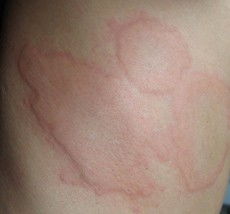 荨麻疹的症状和治疗方法:警惕!荨麻疹的症状与治疗方法全解析 荨麻疹的症状和治疗方法:警惕!荨麻疹的症状与治疗方法全解析