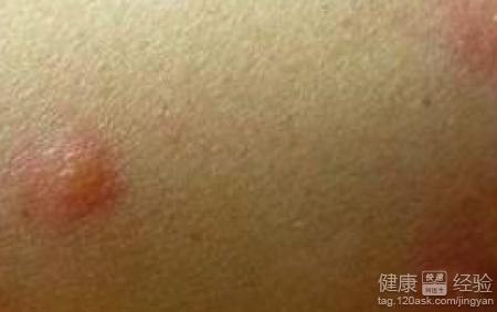 荨麻疹的症状和治疗方法:警惕!荨麻疹的症状与治疗方法全解析 荨麻疹的症状和治疗方法:警惕!荨麻疹的症状与治疗方法全解析