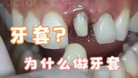 牙冠和牙套是一回事吗:牙冠和牙套是一回事吗? 牙冠和牙套是一回事吗:牙冠和牙套是一回事吗?