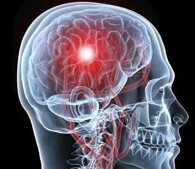 脑梗的早期症状有哪些:脑梗的早期症状有哪些?如何及时识别和应对? 脑梗的早期症状有哪些:脑梗的早期症状有哪些?如何及时识别和应对?