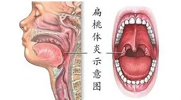 扁桃体发炎十大禁忌:扁桃体发炎的十大禁忌,你必须知道! 扁桃体发炎十大禁忌:扁桃体发炎的十大禁忌,你必须知道!