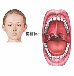 扁桃体发炎十大禁忌:扁桃体发炎的十大禁忌,你必须知道! 扁桃体发炎十大禁忌:扁桃体发炎的十大禁忌,你必须知道!
