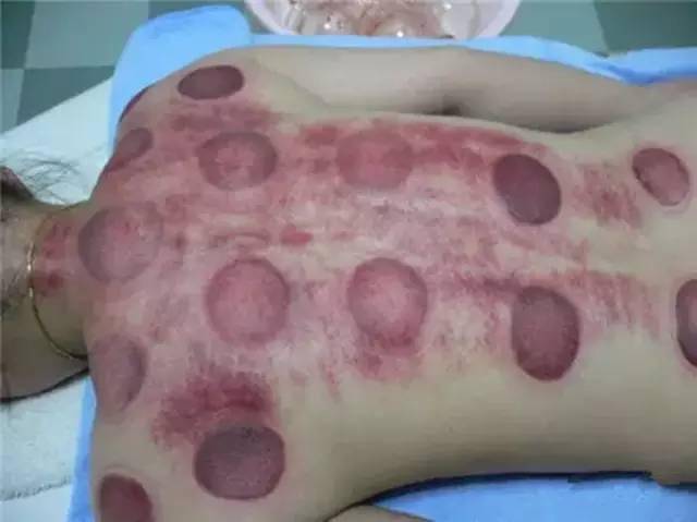 拔罐颜色症状对照表:揭秘拔罐颜色与健康密码,一张图读懂身体状况 拔罐颜色症状对照表:揭秘拔罐颜色与健康密码,一张图读懂身体状况