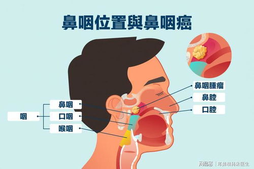 鼻咽癌早期三大症状:警惕!这三种症状可能是鼻咽癌的信号