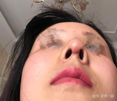 割眼袋哪里医院比较好:割眼袋哪里医院比较好?选择标准与避坑指南 割眼袋哪里医院比较好:割眼袋哪里医院比较好?选择标准与避坑指南